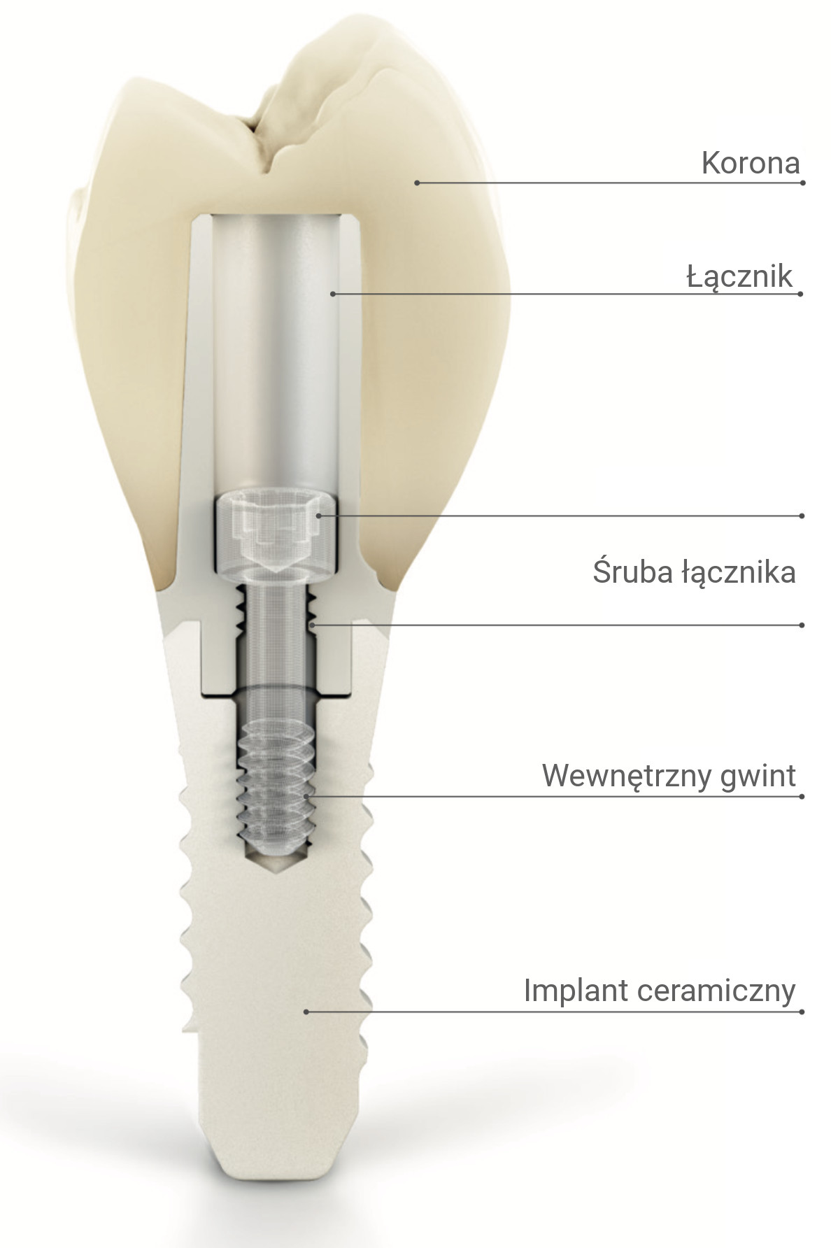 Anatomia Implantu Ceramicznego